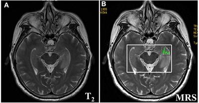 Clinical Characteristics of Cognitive Impairment and 1-Year Outcome in Patients With Anti-LGI1 Antibody Encephalitis